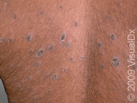 This image displays the round or oval lesions of pityriasis rosea following skin lines like 