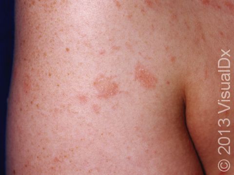 In pityriasis rosea there are slightly raised pink, scaly lesions.