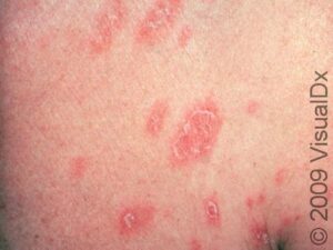 Pityriasis Rosea Condition, Treatments and Pictures for Teens - Skinsight