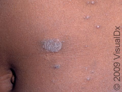 Pityriasis rosea in people with darker skin can look more brown than pink.