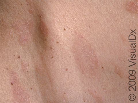 This image displays very fine, scaly, oval, slightly elevated lesions typical of pityriasis rosea.