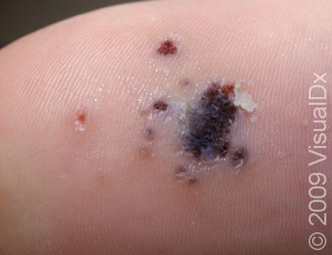 This image displays a plantar wart with black color within it, due to the clotting of blood vessels in the skin.