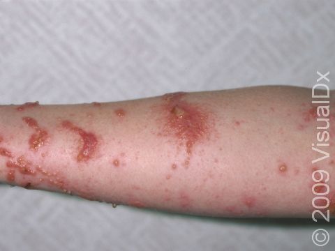 Poison ivy (Eastern U.S.) or poison oak (Western U.S.) is a delayed allergic reaction. Brushing the plant on the skin results in blisters and slightly elevated lesions 1-2 days after exposure, accompanying a severe itch.