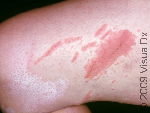 This image displays a rash with a linear distribution typical of poison ivy.
