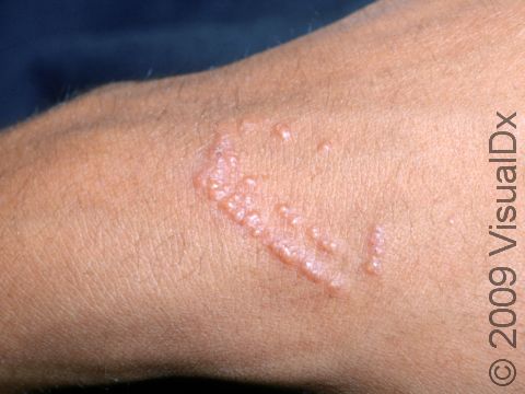 This image displays fluid-filled blisters typical of the intense allergic reaction of poison ivy dermatitis.