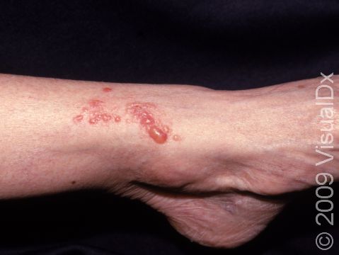 This image displays poison ivy dermatitis where the allergen touched the skin.