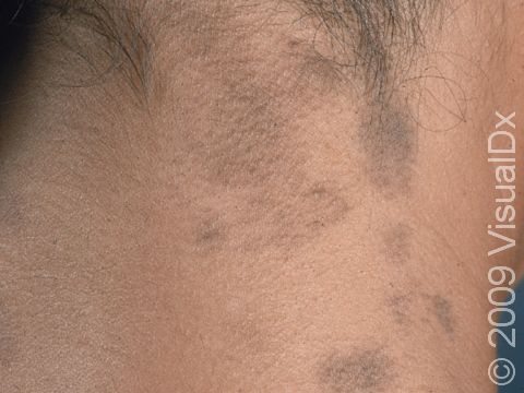 Darkening of the skin in an area that was previously inflamed is common.