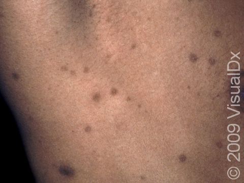 This image displays post-inflammatory hyperpigmentation (dark flat marks left after a skin problem has healed).