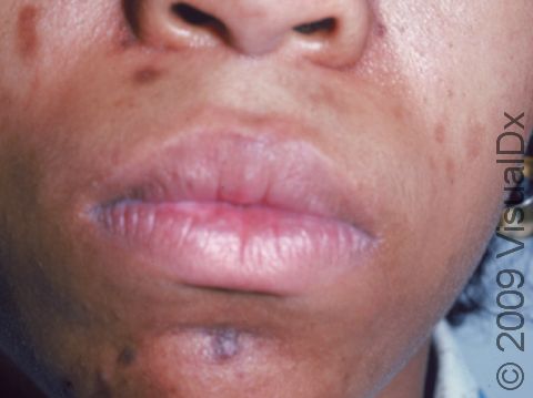 Dark skin spots often follow acne lesions in Black patients.