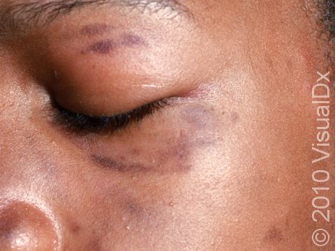 This image displays deep skin darkening following a skin rash.