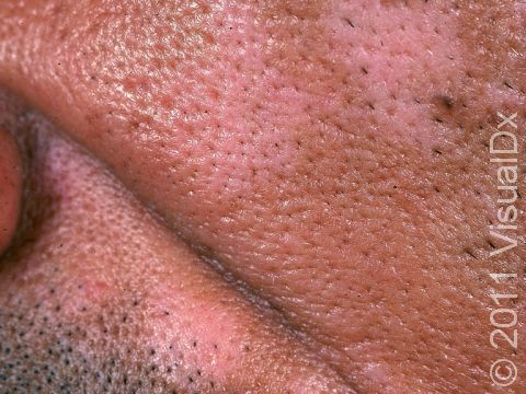 This patient had a rash that resulted in pigment loss typical of postinflammatory hypopigmentation.