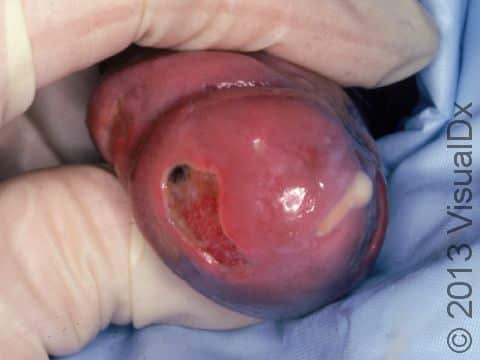 Gonorrhea in a male is typically displayed as a discharge from the penis, while redness and an ulceration on the tip of the penis can also be displayed, as seen in this image.