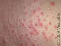 PUPPP (Pruritic Urticarial Papules Plaques of Pregnancy)