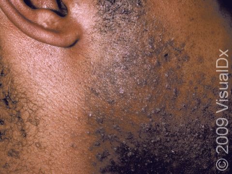 Elevations of the skin and pus-filled lesions in the follicles of the beard area are typical of pseudofolliculitis barbae (razor or shaving bumps).