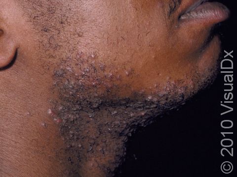 In pseudofolliculitis barbae (also called razor bumps or shaving bumps), there are slightly elevated, sometimes pus-filled, lesions in the beard area due to ingrown hairs.