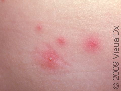 This image displays a pseudomonas infection in the skin pores.