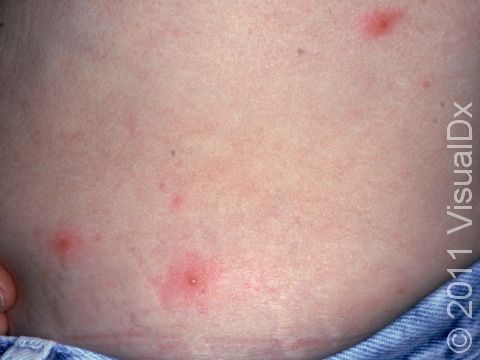 This image displays the red areas typical of pseudomonas folliculitis (hot tub folliculitis).