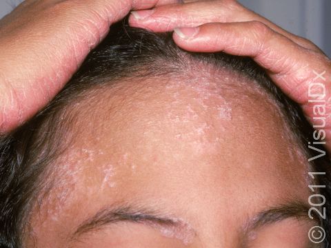 This image displays a forehead and scalp affected by psoriasis.