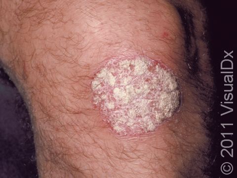 In psoriasis, this is a typical elevated lesion with white scale on the knee.