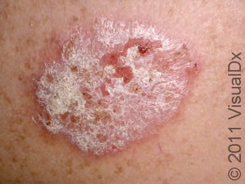 psoriasis_3732_lg.jpg?mtime=20161027102532#asset:162896