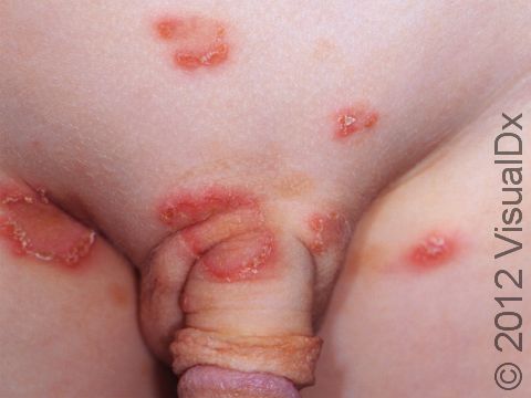 Psoriasis is common in the genital region, where the scaling is not as prominent due to moisture in this region.