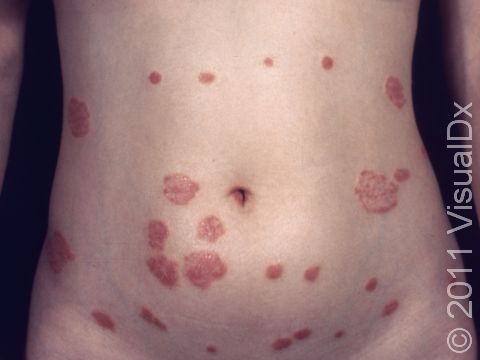Psoriasis typically has sharp boundaries between normal skin and involved areas.