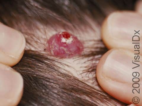 Pyogenic granulomas can occur quickly on almost any part of the body. They are typically red to deep red and bleed easily.