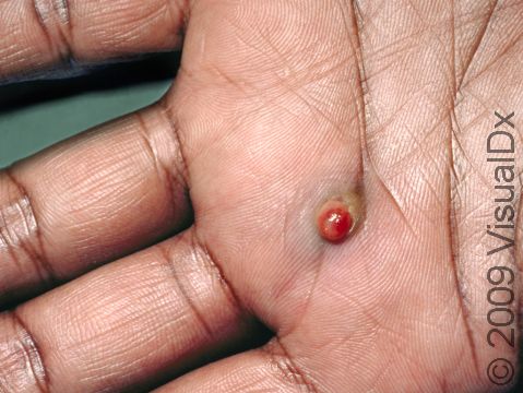 Pyogenic granulomas are soft to the touch and often have a bloody surface.
