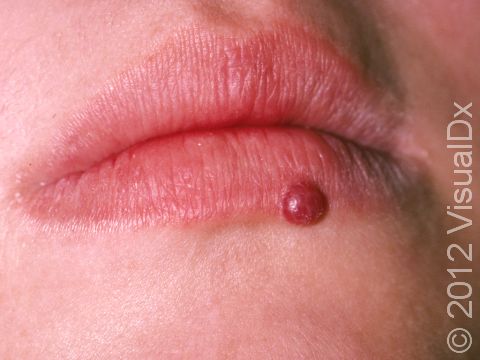 Pyogenic granulomas appear and enlarge in days, and they are usually deep red and sometimes bleed easily.