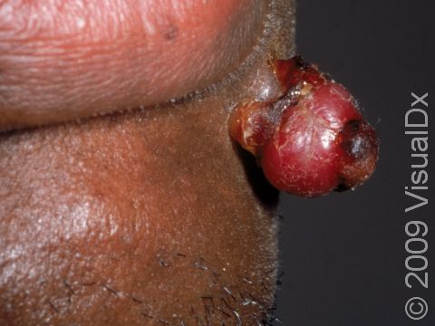 This image displays a pyogenic granuloma, which has grown far off the skin surface and bleeds when traumatized.