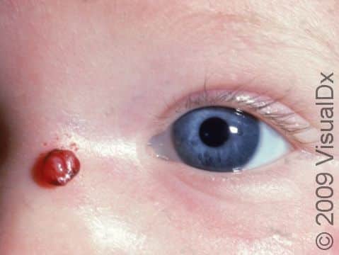 Lobular capillary hemangiomas sometimes are connected to the skin by a small 
