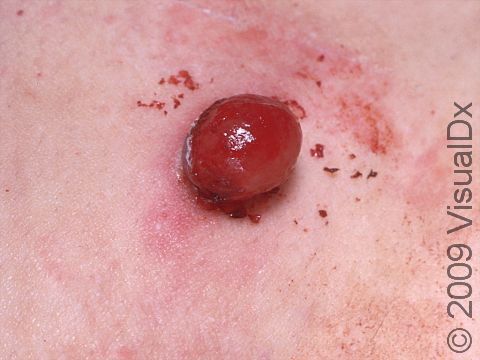 Lobular capillary hemangiomas often appear moist and bloody.