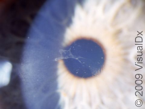 The irregularity of the layer of cells that covers the surface of the cornea (corneal epithelium), seen here, is common in recurrent erosion.