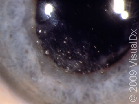 This is another example of the irregularity of the layer of cells that covers the surface of the cornea (corneal epithelium) often seen in recurrent erosion.