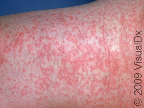 This image displays the rash associated with rubella (German measles).