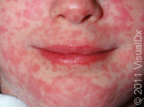 This image displays the measles rash, which typically starts on the face and then spreads down the body.