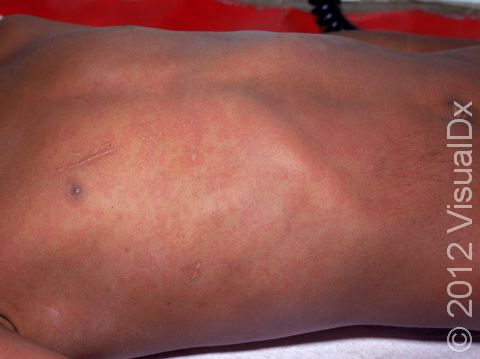 In people with darker skin colors, the diffuse pink-to-red rash of measles is harder to see; the few normal areas of skin can be seen near the nipple area in this child.