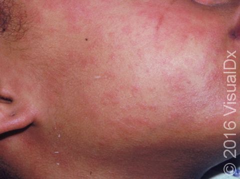 This image displays a rash on the face typical of measles in its early stage.