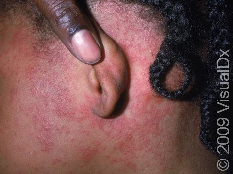 The measles rash often appears behind the ears when it starts on the face.