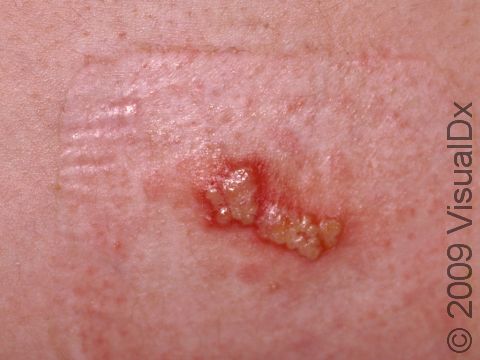 This image displays grouped herpes lesions on the thigh.