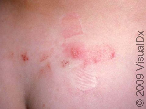This image displays grouped lesions typical of sacral herpes simplex.