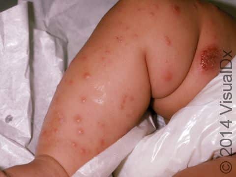 This image displays an infant with a variant (with firm skin lesions) of scabies. A superficial bacterial skin infection, caused by scratching, is present at the thigh.
