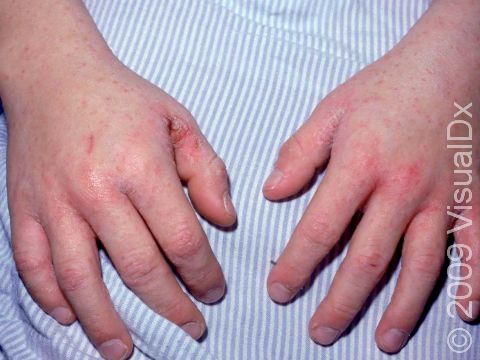 This image displays sores, bumps, and scabs in the finger and wrist area typical of scabies.