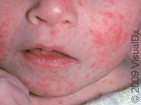 Seborrheic dermatitis can cause redness on the face.