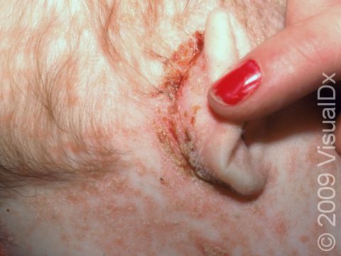 Seborrheic dermatitis (cradle cap) often causes cracking and scaling in the crease behind the ear as well as involving the face and scalp.