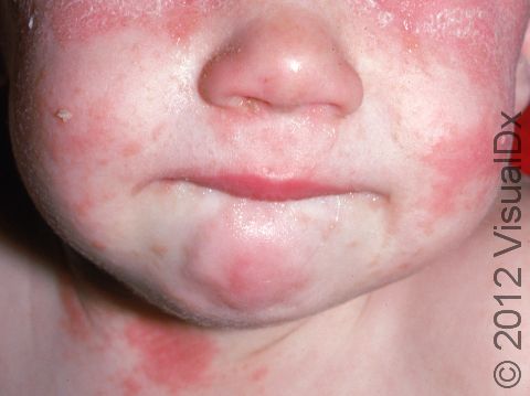Seborrheic dermatitis can have pink, scaly, slightly elevated lesions, typically involving the head and neck.