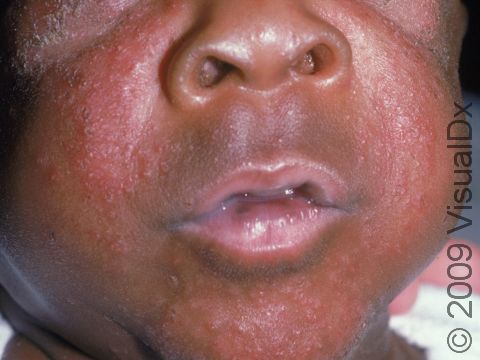 Seborrheic dermatitis can also have small bumps (papules) on infants.