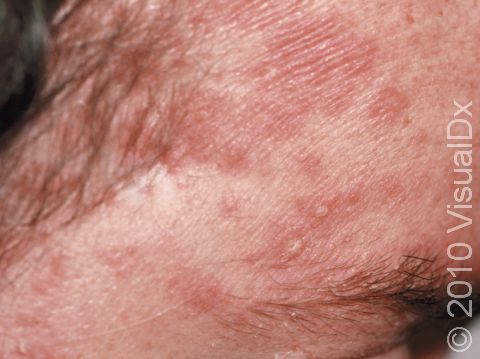 Scaly, slightly elevated lesions of seborrheic dermatitis typically involve the hair line, scalp, and forehead. This is a severe case.