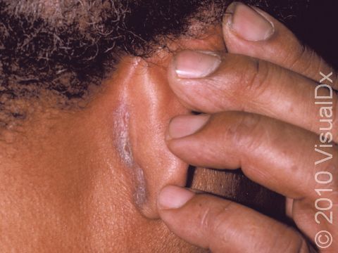 The fold behind the ear is a common location for seborrheic dermatitis.