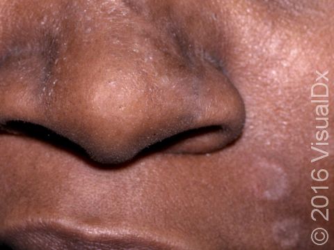 This image displays slightly scaly, ring-shaped lesions typical of seborrheic dermatitis.